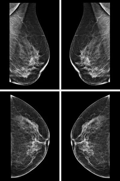 Laterale mammogram van vrouwelijke borst — Stockfoto