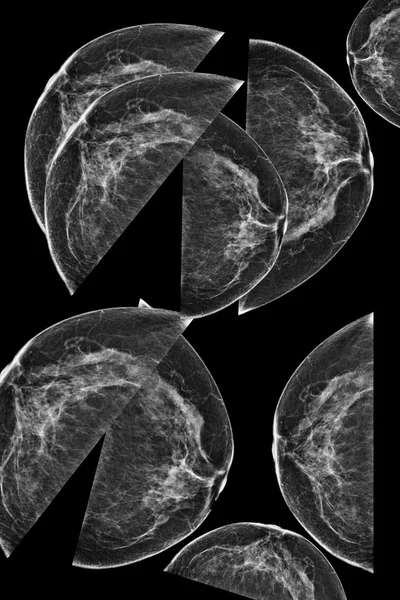 A női mell oldalsó mammogram — Stock Fotó