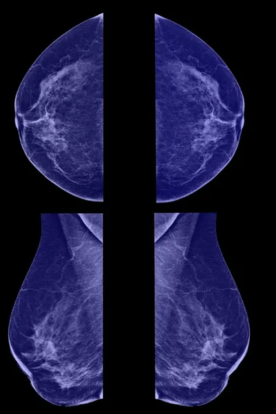 Mamografía lateral de mama femenina — Foto de Stock
