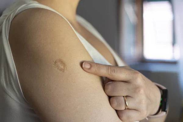 Monkeypox and smallpox vaccine concept: woman shows smallpox vaccine scar on her arm