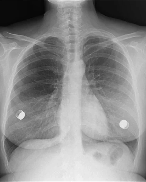 Chest x-ray of a woman with breast expanders following breast cancer surgery