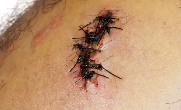 Points de suture sur la jambe — Photo