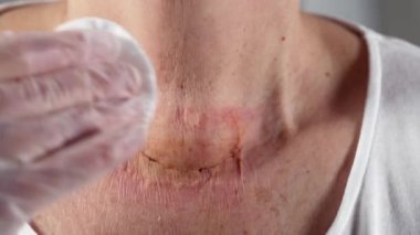 Hemşire ameliyattan sonra yaşlı bir insanın boğazındaki sargıyı değiştiriyor.