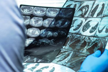 Maskeli doktor iki MR taramasını inceler ve karşılaştırır..