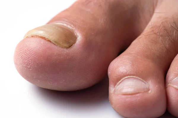 Toe nail with psoriasis and healthy toe nails, Psoriatic nail, close-up