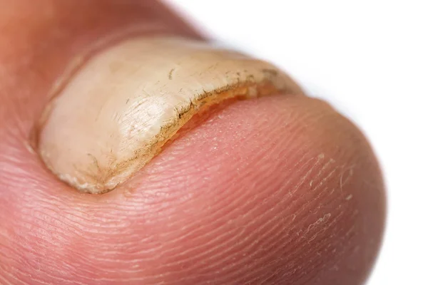Toe nail with psoriasis and healthy toe nails, Psoriatic nail, close-up