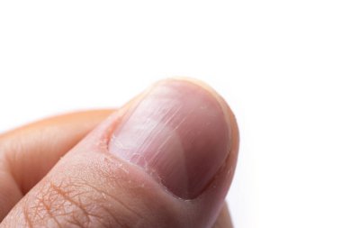 Ridged fingernail of a thumb finger of a man with vertical ridges on white background. clipart