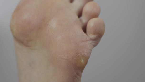 Ein Mann legt ein Pflaster auf eine Warze am Bein. Behandlung Plantarwarze, Makro — Stockvideo