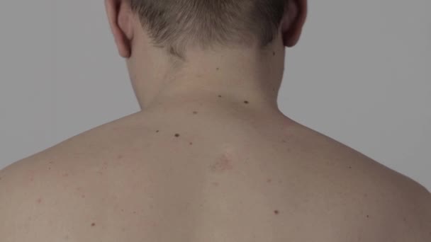 Een man lijmt een medisch pleister aan de nekwervel, close-up — Stockvideo