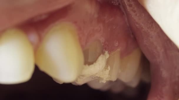 Tijdelijke vullingen op tanden na pulpitis behandeling. Tijdelijke vullingen in de tandheelkunde, macro — Stockvideo