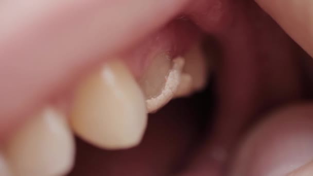 Rellenos temporales en los dientes después del tratamiento de pulpitis. Rellenos temporales en odontología, macro — Vídeo de stock
