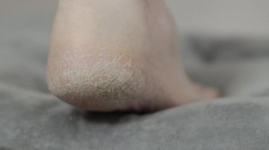 Bir insanın ayağında kurumuş, sorunlu bir cilt, yakın plan. Çatlamış deri, makro.