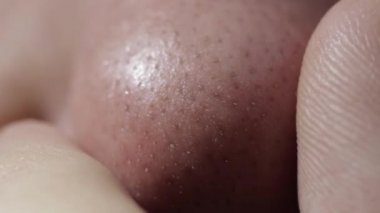 Siyah noktalı ve sivilceli birinin burnundaki yağlı deri. Yüz bakımı, cilt bakımı, makrografi.