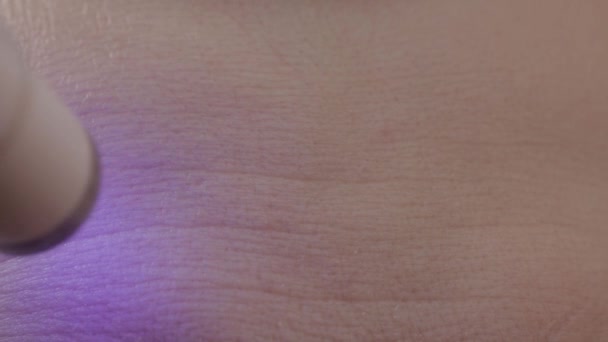 Traitement des pores et de la peau sur le visage avec un stylo laser de cosmétologie, macro — Video