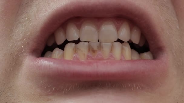 Romlott emberi fogak, közelkép. Fogászati számítás a fogászatban, fekete fog, probléma — Stock videók