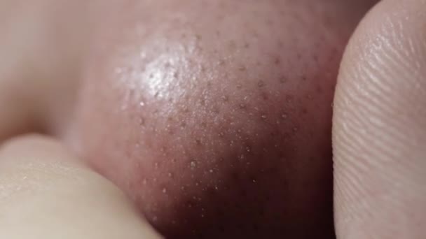 Vette huid op de neus van een persoon met mee-eters en acne. Gezichtsverzorging, dermatologie, macro — Stockvideo