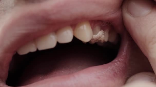 Remplissage temporaire des dents après traitement de la pulpite. Remplissage temporaire en dentisterie, macro — Video