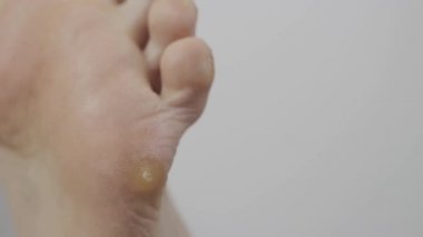 Beyaz arka planda bir adamın ayağında ayak siğili, makro. Metin için alanı kopyala