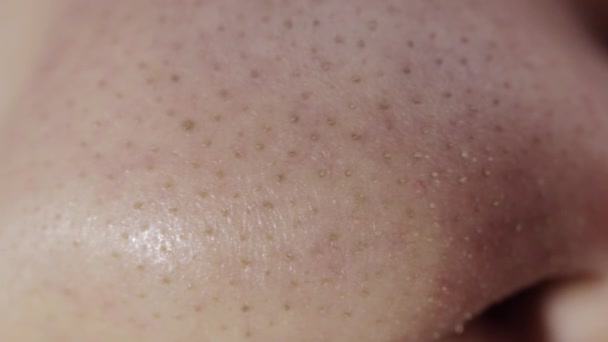 Piel grasa en la nariz de una persona con puntos negros y acné. Cuidado facial de la piel, dermatología, macro — Vídeos de Stock