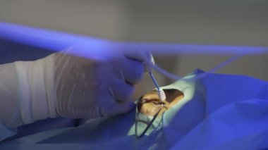 Gülümseme metodunu kullanarak lazer göz düzeltme. Doktor hastanın korneasını siliyor.