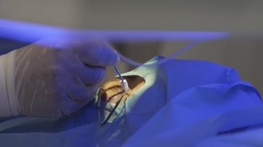 Gülümseme metodunu kullanarak lazer göz düzeltme. Doktor gözünden fazla kan alıyor..