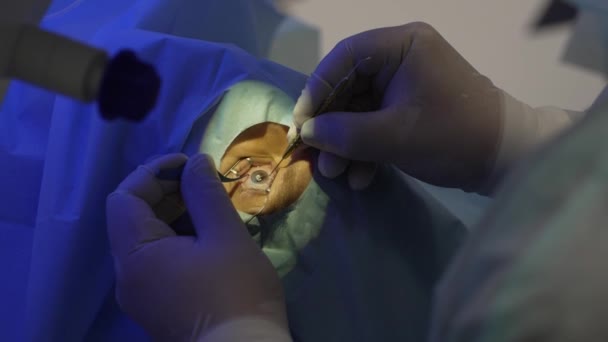 Mains chirurgiens enlève une partie de la cornée de l'œil avec une pince à épiler — Video