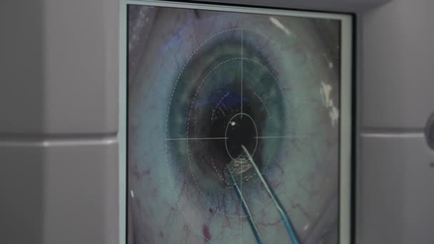 Remover parte da córnea do olho com pinças na tela do monitor — Vídeo de Stock