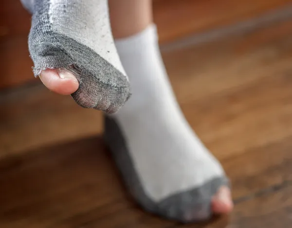 Worn out socks with a hole and toes. — Stock Photo, Image