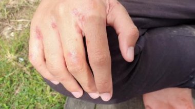 Ülser iltihaplanmasına, uyuz enfeksiyonuna, hassas cilt kaşıntısına bağlı iltihapla dolu.