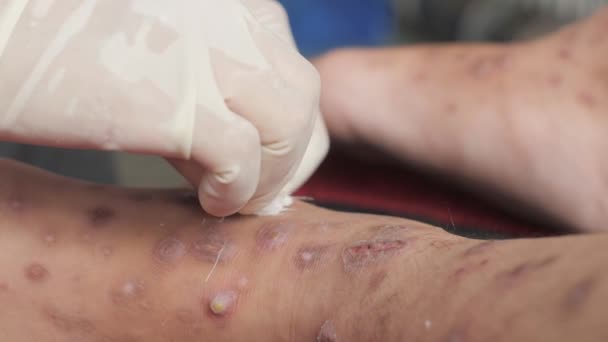 Közelkép Nővér Kéztisztító Beteg Láb Fekély Tele Gyomorfekély Okozta Rüh — Stock videók