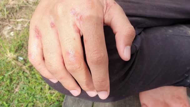 Close Hand Ulcer Filled Pus Condition Caused Scabies Infection Sensitive — Vídeos de Stock