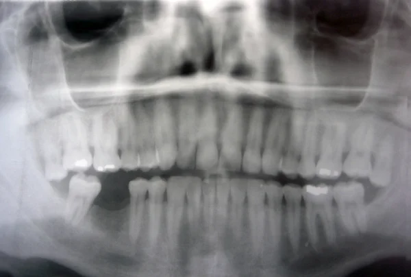 X-ray van iemands tanden — Stockfoto