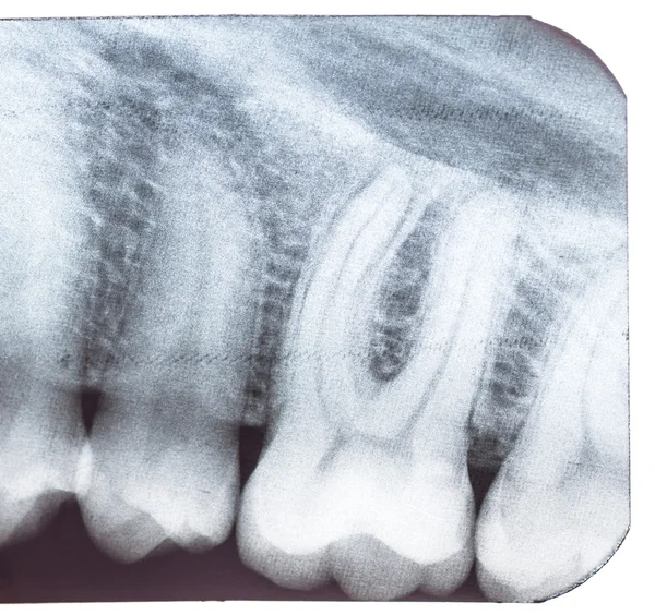 Tooth x-ray. — Stock Photo, Image