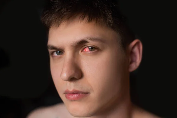 Konjonktivitten Gripten Soğuk Algınlığından Alerjiden Etkilenen Bir Erkeğin Kırmızı Gözünü — Stok fotoğraf