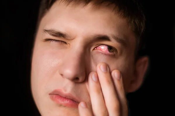 Close Olho Sangue Vermelho Irritado Sexo Masculino Afetado Por Conjuntivite — Fotografia de Stock