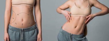 kavram üstüne kavram. Gri arka planda düzgün vücut cerrahisi kolajı. Estetik ameliyat veya liposuction sonrası ortaya çıkan sonuç