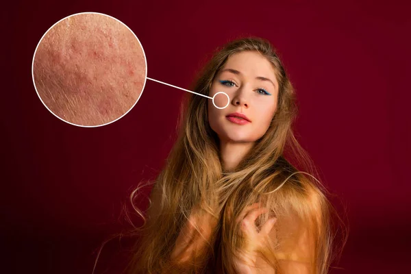 Face Feminina Perto Mostrar Problemas Pele Pele Seca Acne Rugas — Fotografia de Stock