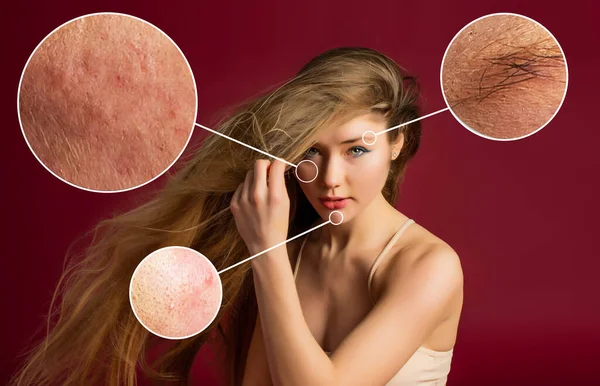Female Face Close Show Skin Problems Dry Skin Acne Wrinkles — Fotografia de Stock