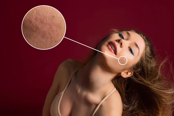 Face Feminina Perto Mostrar Problemas Pele Pele Seca Acne Rugas — Fotografia de Stock