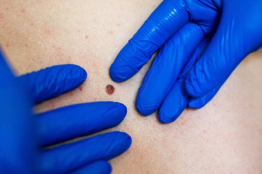 a doctor in blue gloves examines a large birthmark and birth defects. concept of clean skin