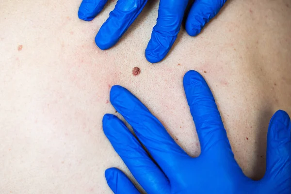 Doctor Blue Gloves Examines Birthmark Birth Defects Concept Clean Skin — Fotografia de Stock