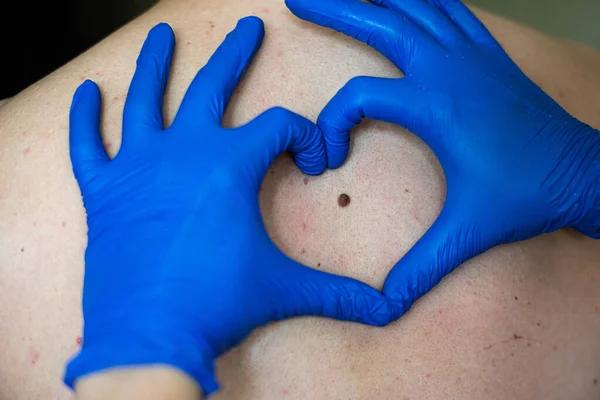 Doctor Blue Gloves Shows Heart Symbol Background Patient Birthmark — Fotografia de Stock