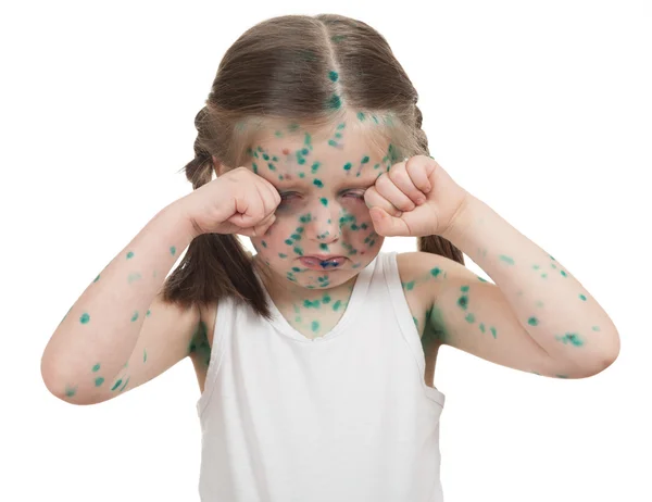 Sick child. chickenpox — Stock Photo, Image