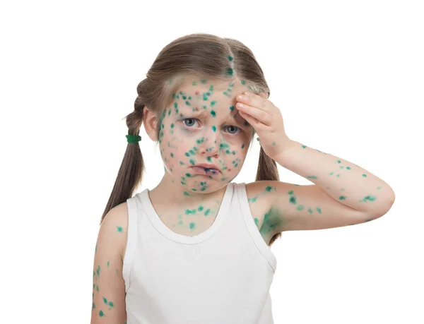 Sick child. chickenpox — Stock Photo, Image