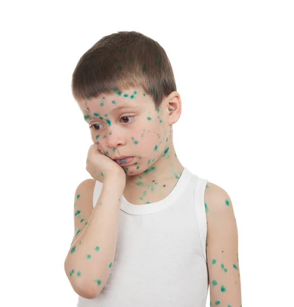 Sick child. chickenpox — Stock Photo, Image