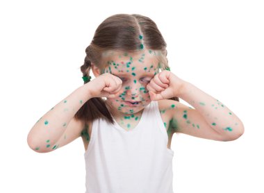 acnes çocuk üzerinde. su çiçeği