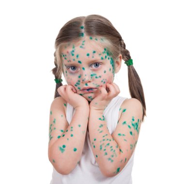 acnes çocuk üzerinde. su çiçeği
