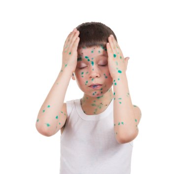 acnes çocuk üzerinde. su çiçeği