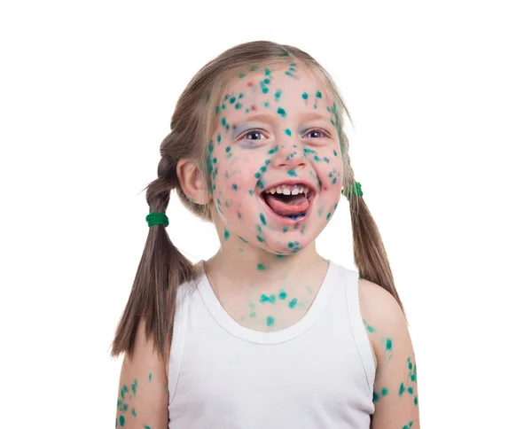 Acnes en el niño. varicela — Foto de Stock