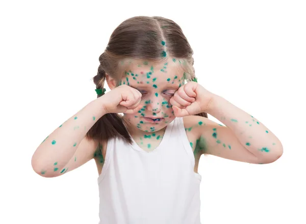 Acnes on child. chickenpox — Stock Photo, Image